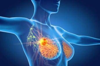 tumore al seno triplo negativo speranze da anticorpo farmaco coniugato 2