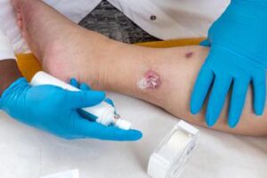 idrosadenite suppurativa le iniziative di ucb per migliorare diagnosi e cura 2