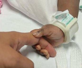 gemelle siamesi separate al gaslini di genova estubate respirano da sole 2