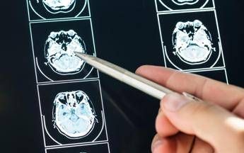 intelligenza artificiale puo prevedere evoluzione parkinson lo studio italiano 2
