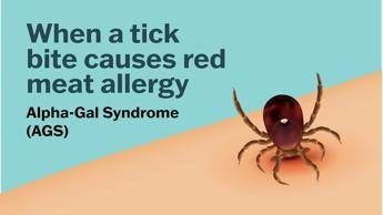 se una zecca rende allergici a carne e latticini cose la sindrome alfa gal 2