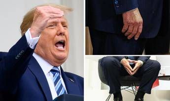 trump e le gambe gonfie cose linsufficienza venosa cronica 2
