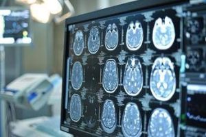 giornata mondiale dellalzheimer neurologi ora percorsi cura piu efficaci e sostenibili 2