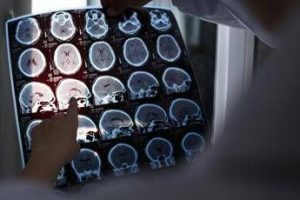nuove molecole e bersagli cosi si evolve la terapia contro lalzheimer il punto 2