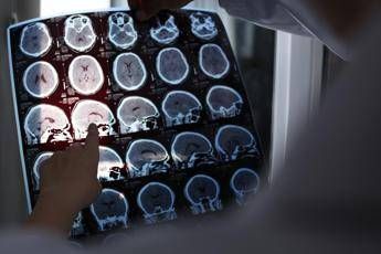 nuove molecole e bersagli cosi si evolve la terapia contro lalzheimer il punto 2