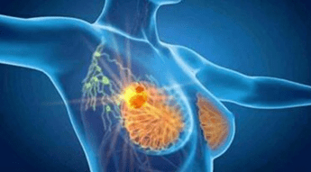 cancro seno con profilazione molecolare e terapie target migliori prospettive di cura 2