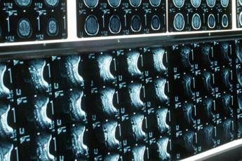 ipofosfatemia legata allx primo bilancio e prospettive su linee guida 2