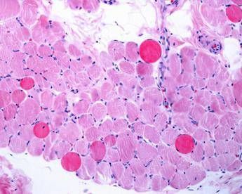 malattie rare risultati positivi a 5 anni per vamorolone in distrofia duchenne 2