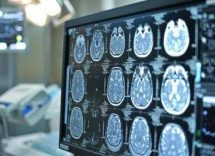 sanita presentato deestrategy modello per continuita assistenziale in encefalopatie rare 2