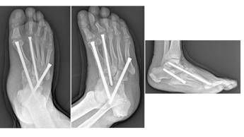 piede di charcot al gemelli soluzioni avanzate per una complicanza rara del diabete 2