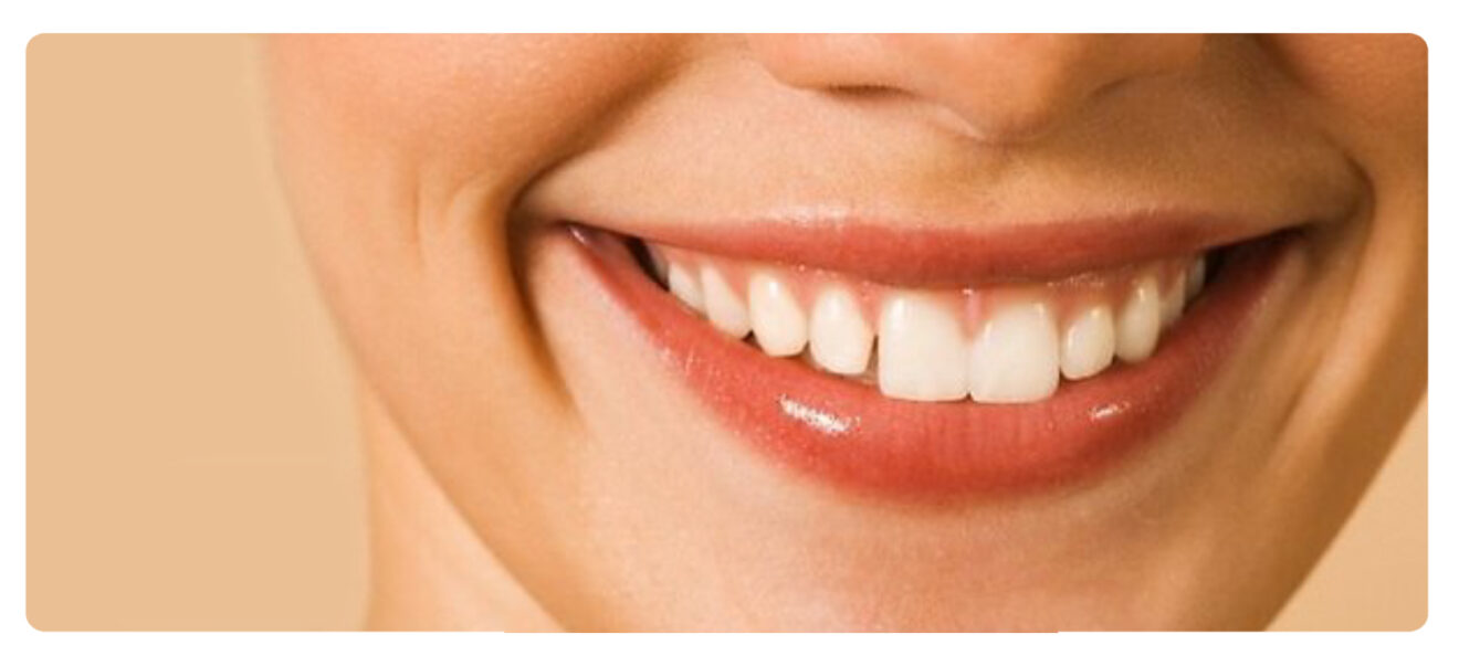 sorriso perfetto 2