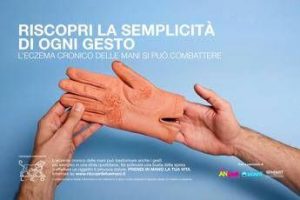 mani che bruciano e fanno male al via campagna su eczema cronico 2