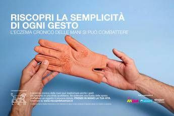 mani che bruciano e fanno male al via campagna su eczema cronico 2