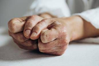 open day psoriasi l11 marzo visite gratis in 90 ospedali bollino rosa 2