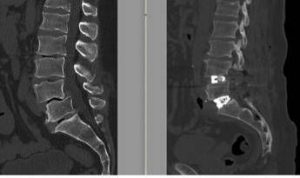 chirurgia vertebrale complessa al tiberia hospital di roma intervento con tecnica alif 2