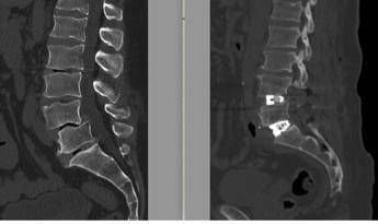 chirurgia vertebrale complessa al tiberia hospital di roma intervento con tecnica alif 2