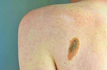 ogni anno in italia 2 600 casi ereditari di melanoma imiprevenzione con test genetici e controlli 2
