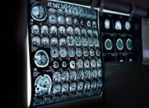 uno spray nasale ferma linvecchiamento del cervello lo studio 2