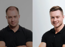 protesi capelli uomo lordhair italia