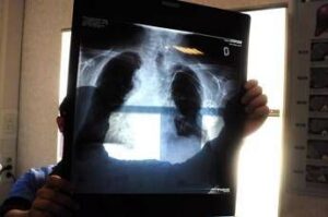 sirm ai strumento anti liste dattesa 50 esami imaging per over70 non necessario 2