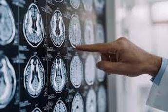 stop tremori parkinson senza bisturi 10 pazienti curati con ultrasuoni a napoli 2