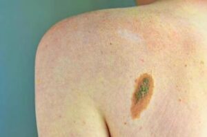 imi bene legge su prevenzione melanoma educare i giovani su rischi 2