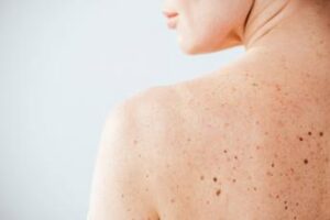 nei e sole sidemast lancia la giornata della prevenzione dermatologica 2